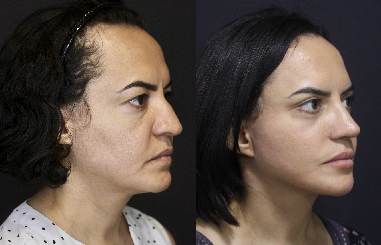 Antes e depois lifting