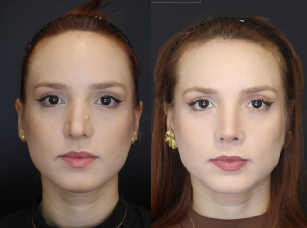 lais frente antes e depois